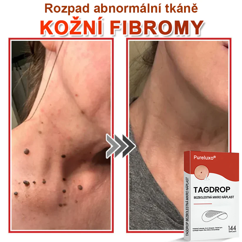 Pureluxo® Mikrovpichová botanická náplast na odstranění kožních výrůstků 🇨🇿 Vyrobeno v Česká republika 🎁