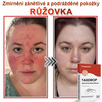 Pureluxo® Mikrovpichová botanická náplast na odstranění kožních výrůstků 🇨🇿 Vyrobeno v Česká republika 🎁