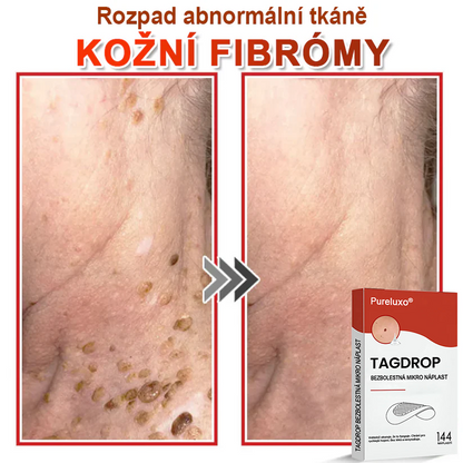 Pureluxo® Mikrovpichová botanická náplast na odstranění kožních výrůstků 🇨🇿 Vyrobeno v Česká republika 🎁
