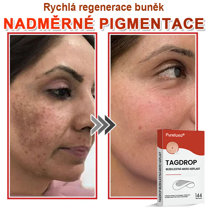 Pureluxo® Mikrovpichová botanická náplast na odstranění kožních výrůstků 🇨🇿 Vyrobeno v Česká republika 🎁