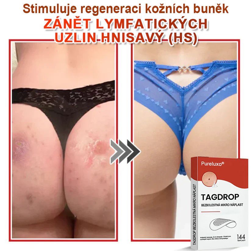 Pureluxo® Mikrovpichová botanická náplast na odstranění kožních výrůstků 🇨🇿 Vyrobeno v Česká republika 🎁