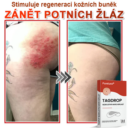 Pureluxo® Mikrovpichová botanická náplast na odstranění kožních výrůstků 🇨🇿 Vyrobeno v Česká republika 🎁